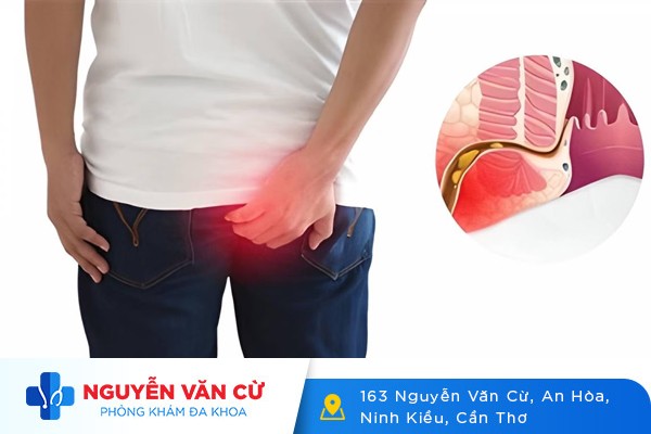 Rò Hậu Môn Là Gì Dấu Hiệu Nhận Biết Và Cách Điều Trị