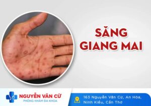 Săng Giang Mai Là Gì? Triệu Chứng Thường Gặp Của Giang Mai