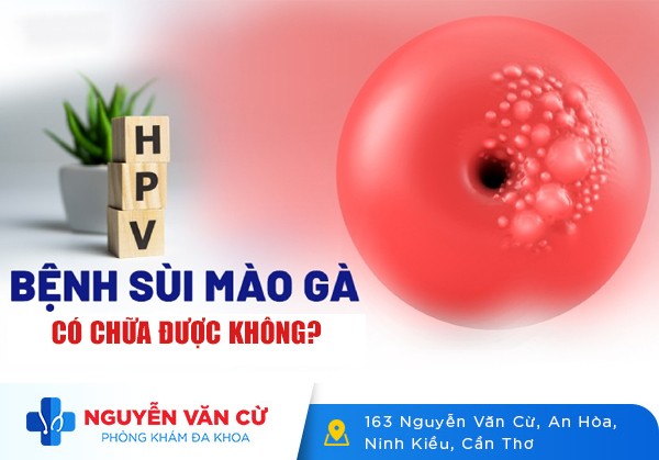 Bệnh Sùi Mào Gà Có Chữa Được Không?