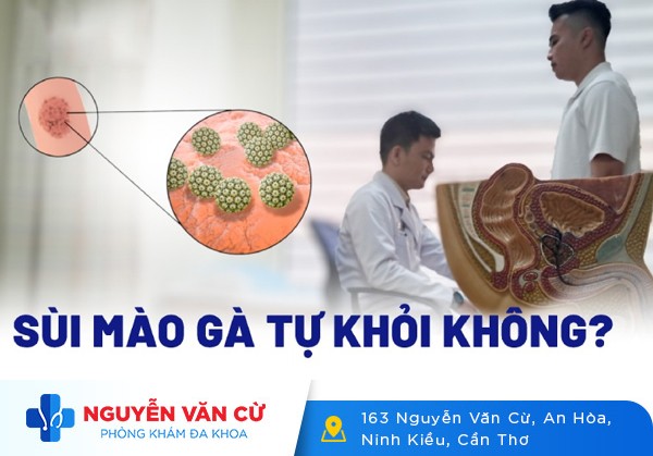 Sùi Mào Gà Có Tự Hết Được Không?