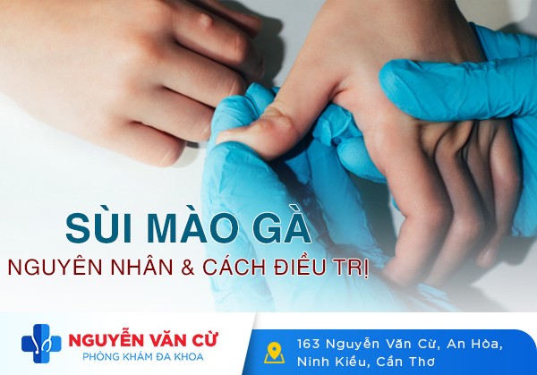 Sùi mào gà: Nguyên nhân và cách điều trị