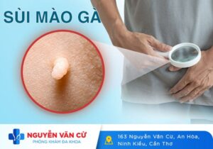 Tại Sao Bị Sùi Mào Gà?