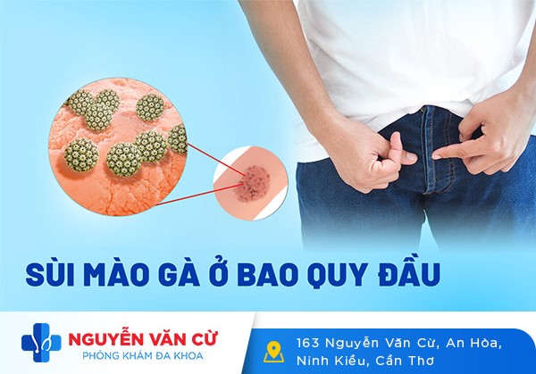 Triệu Chứng Sùi Mào Gà Ở Bao Quy Đầu Là Như Thế Nào?