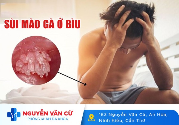 Nhận Biết Biểu Hiện Sùi Mào Gà Ở Bìu