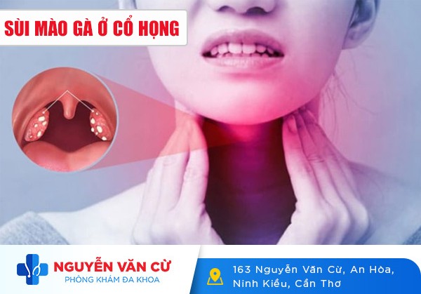 Sùi Mào Gà Ở Cổ Họng Là Như Thế Nào?