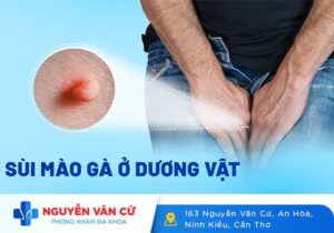 Dấu Hiệu Nhận Biết Sùi Mào Gà Ở Dương Vật Và Phương Pháp Điều Trị