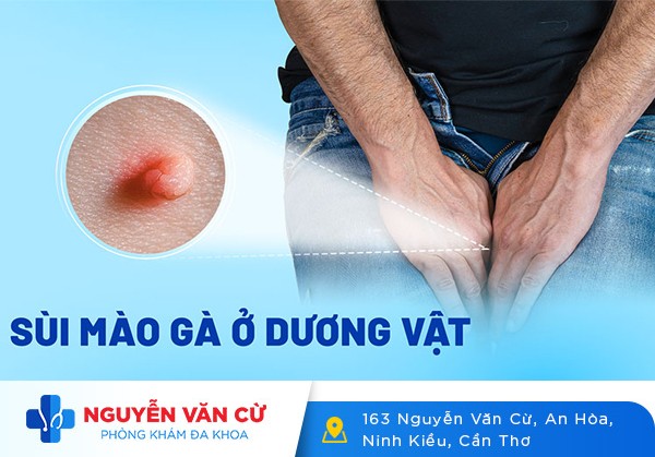 Dấu Hiệu Nhận Biết Sùi Mào Gà Ở Dương Vật Và Phương Pháp Điều Trị
