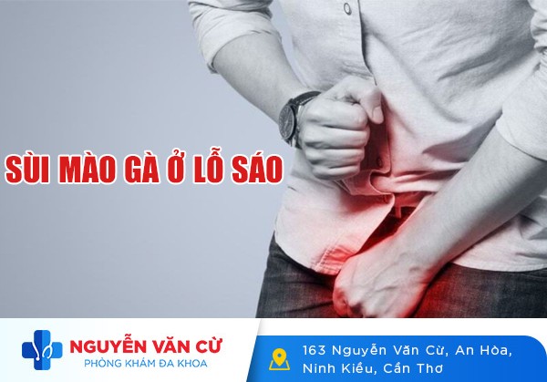 Nhận Biết Biểu Hiện Sùi Mào Gà Ở Lỗ Sáo