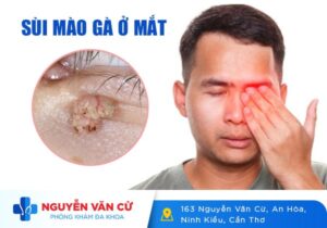 Nhận Biết Triệu Chứng Sùi Mào Gà Ở Mắt Và Cách Điều Trị
