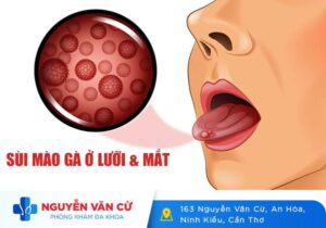 Nhận Biết Sùi Mào Gà Ở Lưỡi Và Mắt