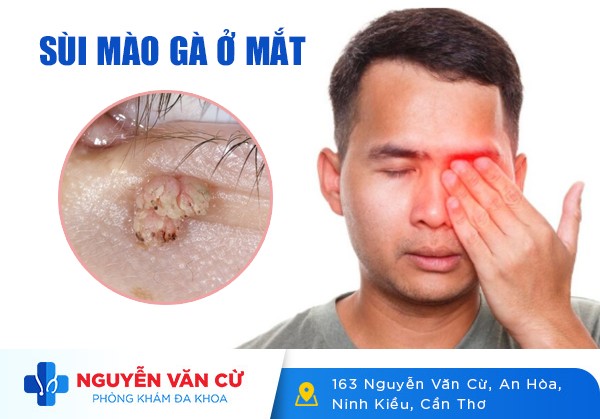 Nhận Biết Triệu Chứng Sùi Mào Gà Ở Mắt Và Cách Điều Trị
