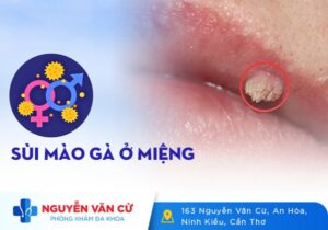 Hình Ảnh Và Dấu Hiệu Nhận Biết Sùi Mào Gà Ở Miệng
