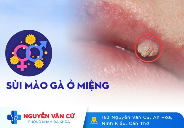 Hình Ảnh Và Dấu Hiệu Nhận Biết Sùi Mào Gà Ở Miệng
