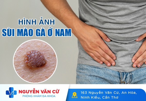 Hình Ảnh Sùi Mào Gà Ở Nam Qua Từng Giai Đoạn
