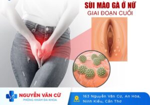 Nữ Bị Sùi Mào Gà Giai Đoạn Cuối Điều Trị Như Thế Nào?