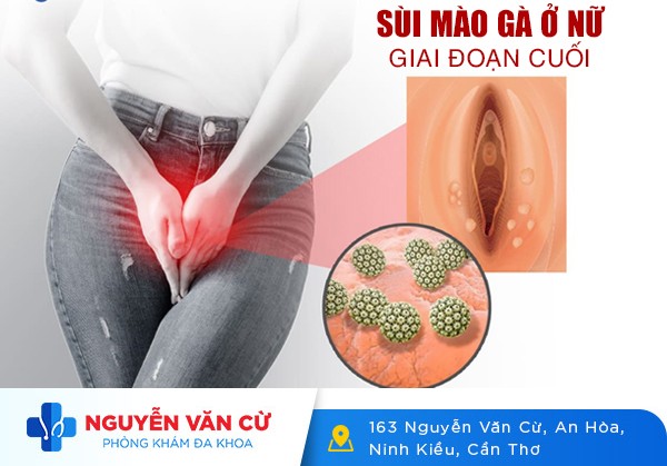 Nữ Bị Sùi Mào Gà Giai Đoạn Cuối Điều Trị Như Thế Nào?