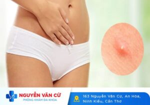 Mọc Mụn Ở Vùng Kín Báo Hiệu Bệnh Gì?