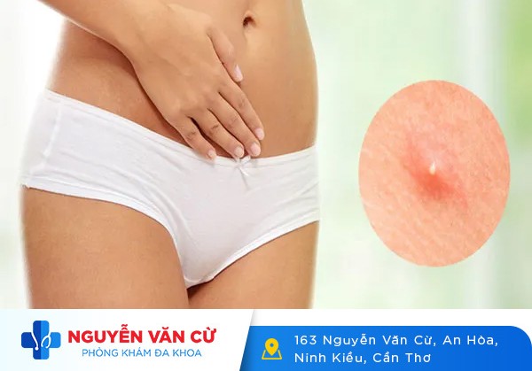 Mọc Mụn Ở Vùng Kín Báo Hiệu Bệnh Gì?