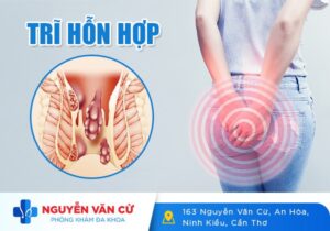 Nguyên Nhân Bệnh Trĩ Hỗn Hợp