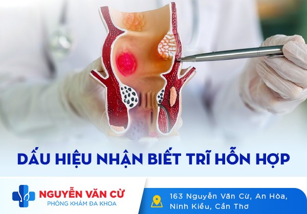 Cách Nhận Biết Dấu Hiệu Của Bệnh Trĩ Hỗn Hợp
