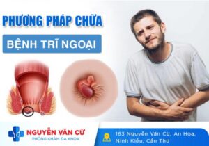 Phương Pháp Chữa Trĩ Ngoại Hiệu Quả