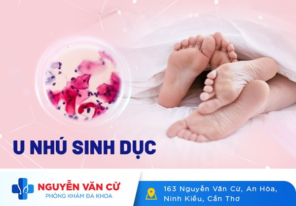 Triệu Chứng Nổi Cục U Nhú Ở Bộ Phận Sinh Dục Nam Và Nữ Là Bệnh Gì?