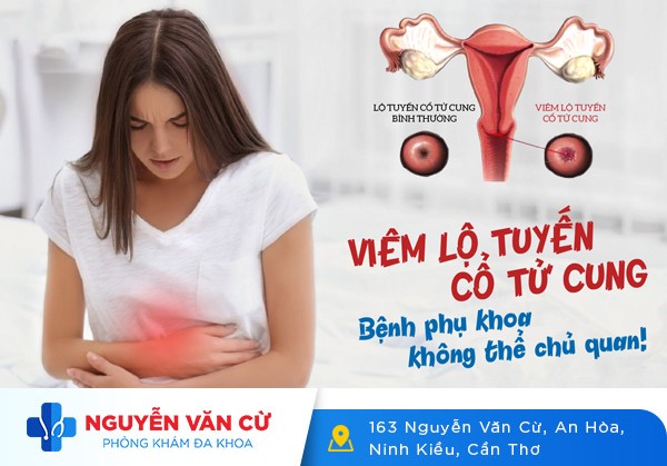 Cách Nhận Biết Dấu Hiệu Bệnh Viêm Lộ Tuyến Cổ Tử Cung